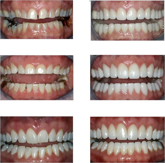 Bruxism Bellville Cape Town Bruxism Bellville Cape Town