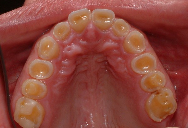 Bruxism Bellville