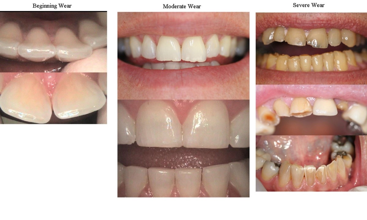 Bruxism Cape Town Bruxism Cape Town