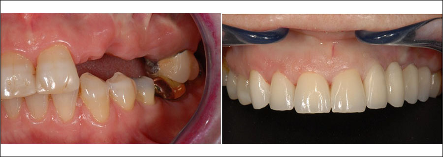 Implants Missing Tooth