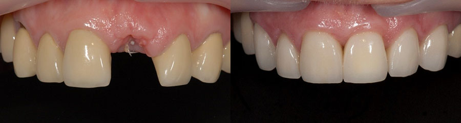 Implants Single Tooth Implants Single Tooth