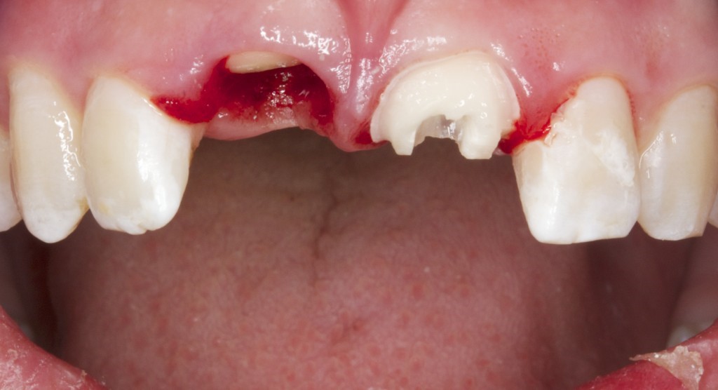 Mouth Guard Bellville Mouth Guard Bellville