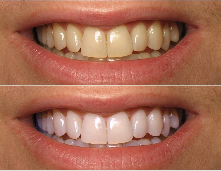 Teeth Whitening Cape Town Teeth Whitening Cape Town