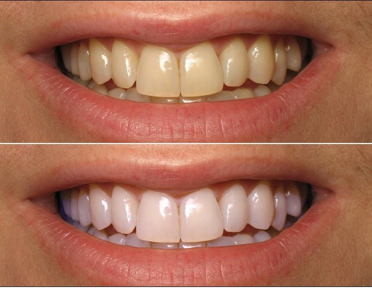 Teeth Whitening Cape Town