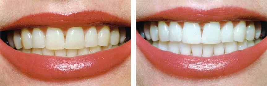 Tooth Whitening Bellville Cape Town Tooth Whitening Bellville Cape Town