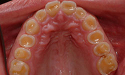 Bruxism Bellville